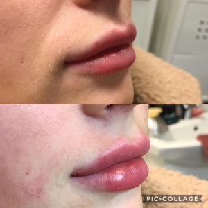 woman lips after and before lip fillers procedure