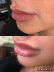 woman lips after and before lip fillers procedure