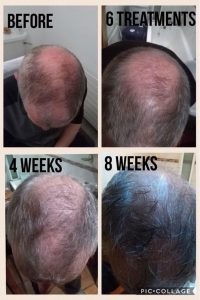 man with hair loss before and after mesotherapy sessions