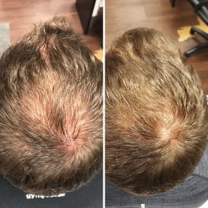 ongoing treatment of hair loss with mesotherapy