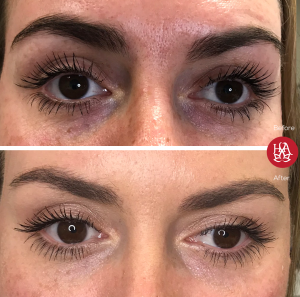 woman before and after dark circles treatment