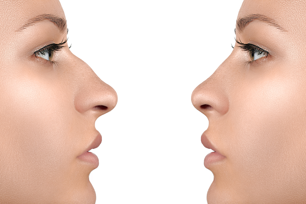 Liquid Rhinoplasty: what to expect