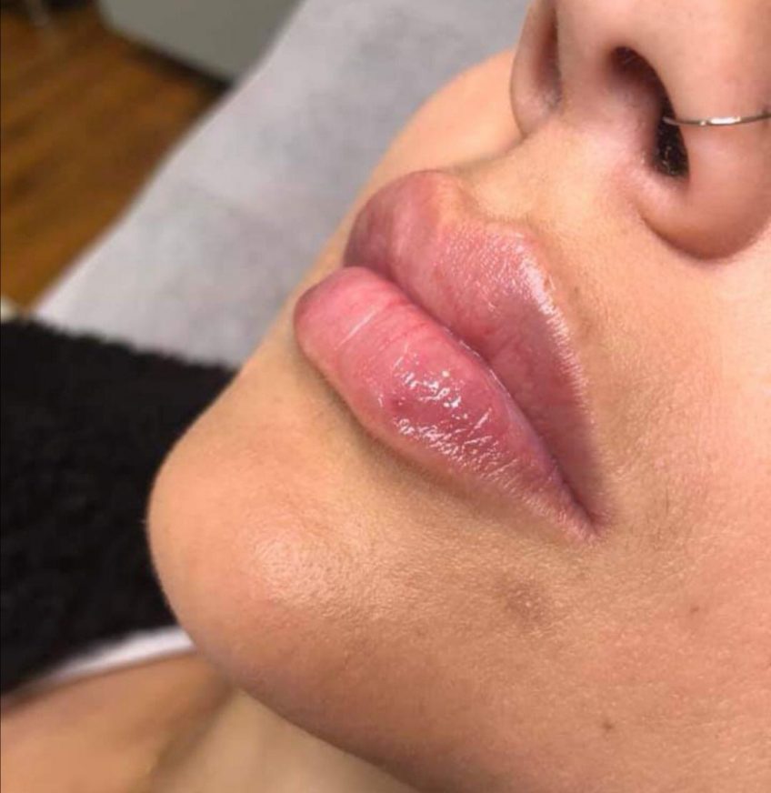 Lip fillers: how they work, how long they last, and more